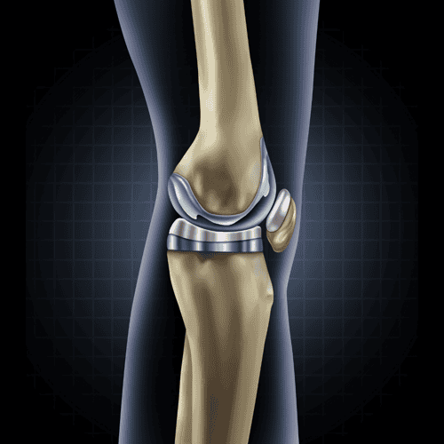 Total Knee Replacement Cost in Turkey: A Comprehensive Guide to Clinics, Reviews, and Packages